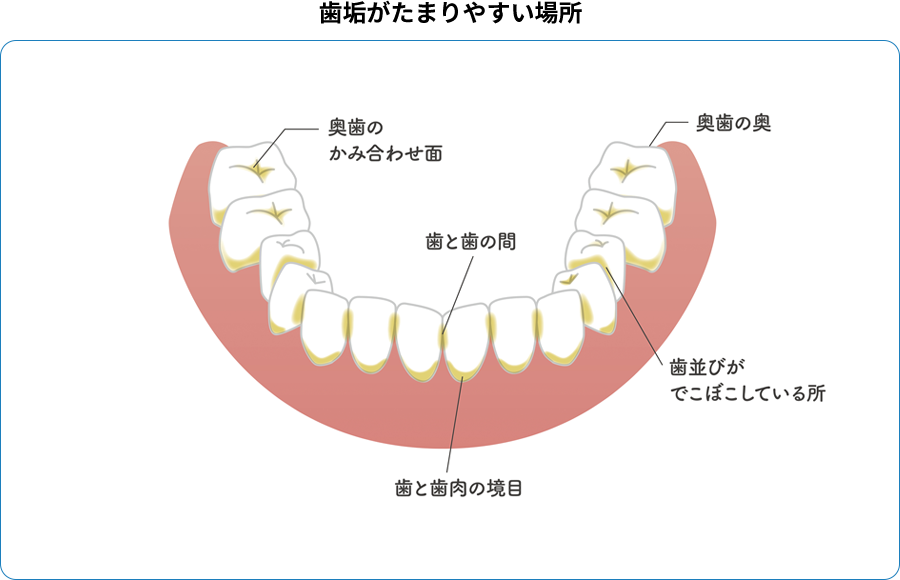 歯垢が溜まりやすい場所